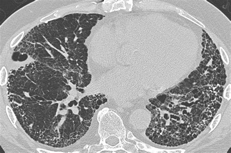Uip Usual Interstitial Pneumonia Ct Scan Image Contribut Flickr