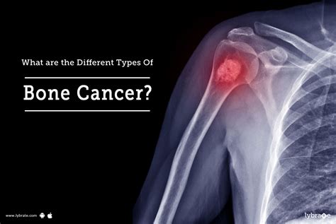 What Are The Different Types Of Bone Cancer By Dr Garima Lybrate