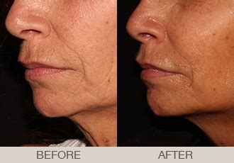 Ultherapy Gallery Aging Lower Face 55 Year Old Female