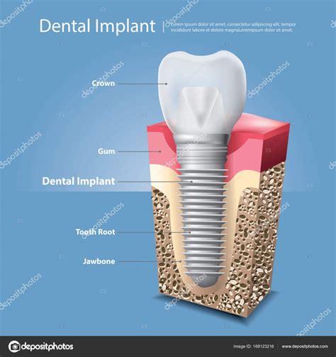 Dientes Humanos E Implante Dental Vector Illustration Vector De Stock