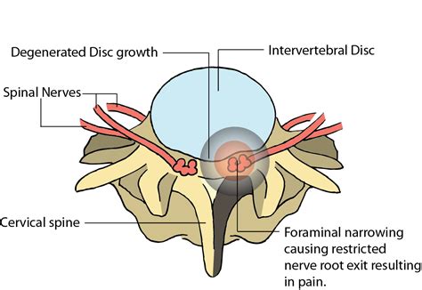 Cervical Foraminal Stenosis Cervical Narrowing And Spine Condition Dr