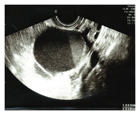Pelvic Ultrasound Showing A Large Complex Ovarian Cyst With Layered