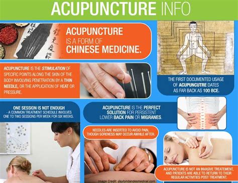 13 surprising benefits of acupuncture you need to know