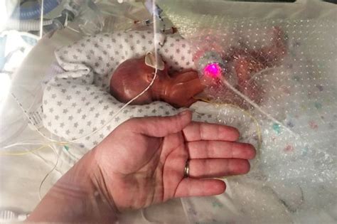 Miracle Baby Born Weighing Just Over Lb With Translucent Skin And Undeveloped Lungs Defies