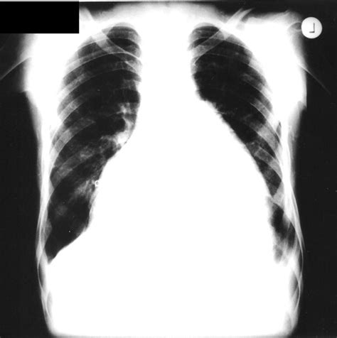 Massive Pericardial Effusion Seen On Chest X Ray Sexiz Pix
