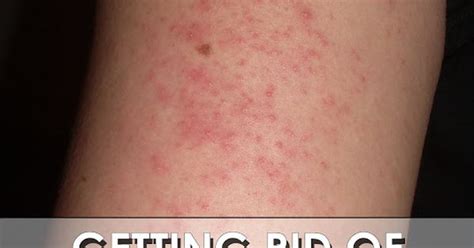 Getting Rid Of Those Little Red Bumps On Your Arms 5 Tips To Getting