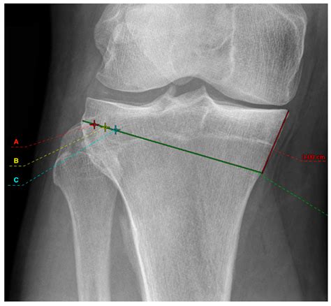 Diagnostics Free Full Text Influence Of Medial Osteotomy Height And
