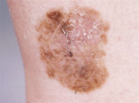 Dermoscopy As A Technique For The Early Identification Of Foot Melanoma