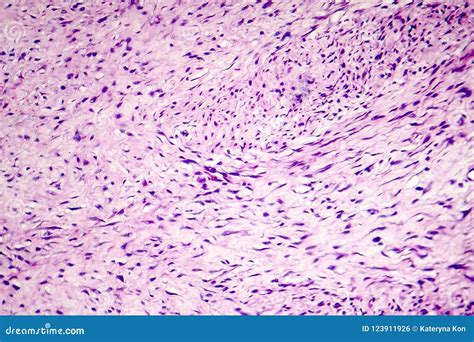 Fibroma A Benign Tumour Of Fibrous Tissue Stock Photo Image Of