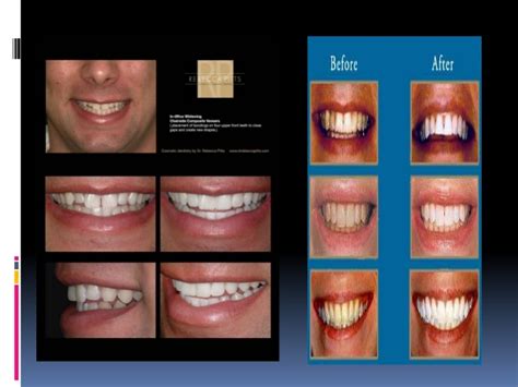 Types Of Veneers Teeth Dental News Network