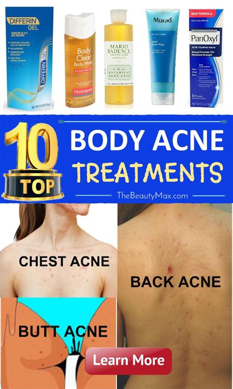 Pin By Acne Go Away On Body Acne Treatment Body Acne Treatment Body