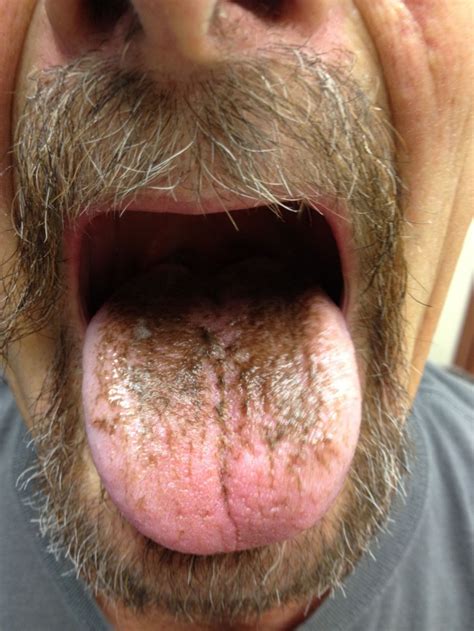 Linezolid Induced Black Hairy Tongue A Case Report Journal Of
