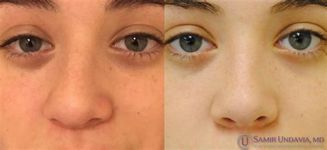 This Is A 3 Month Before And After Rhinoplasty Result Corrected A