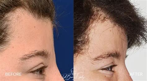 Aesthetic Forehead Surgery Dr Barry L Eppley