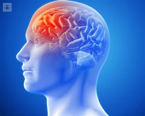 Síntomas y tratamiento de los Tumores Cerebrales Top Doctors