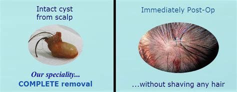 Sebaceous Cyst Removal And Treatment London Dermatology Clinic