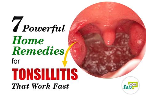 7 Powerful Home Remedies For Tonsillitis That Work Fast Fab How