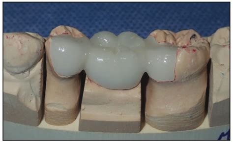 Minimally Invasive Bonded Bridges Vs Implants Dentistry Today