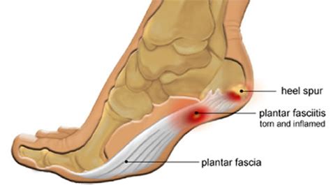 Posterior Tibial Tendonitis Vsplantar Fasciitis Almawi Limited The Holistic Clinic