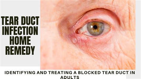 Tear Duct Infection Home Remedy Identifying And Treating A Blocked Tear Duct In Adults Youtube