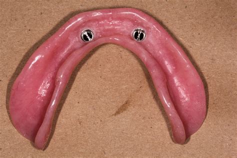 Boise Idaho Prosthodontics Maxillary Complete Denture And Mandibular