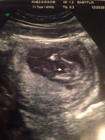 Wrong Gender At Ultrasound Babycenter