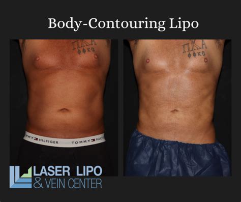 Renuvion Lipo Before And After St Louis Lipo