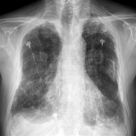 Ct scans' advanced imaging offer much greater details many doctors hail this as the best imaging technology for scans of the chest and abdomen — the two locations where mesothelioma tumors most. Asbestos related lung and pleural disease | Image ...