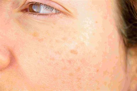Pigmentation And Uneven Skin Tone Laser Clinics New Zealand