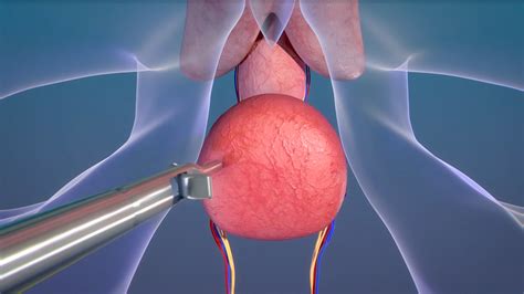 ADDING MULTIMEDIA Levita Magnetics Announces Expanded Indication Of Magnetic Surgical System For