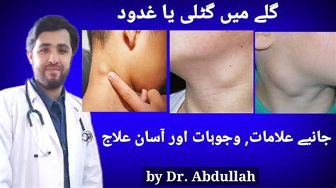 Swollen Lymph Nodes In Neck Symptoms Causes And Treatment