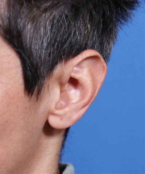 Scapha Reduction Macrotia 10 World Expert In Making Ears Smaller