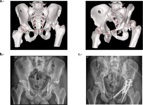 A Left Posterior Hip Dislocation And Complex Acetabular Fracture