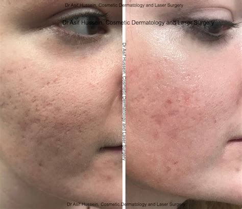 Acne Scar Laser Treatment And Removal London Dr H Consult