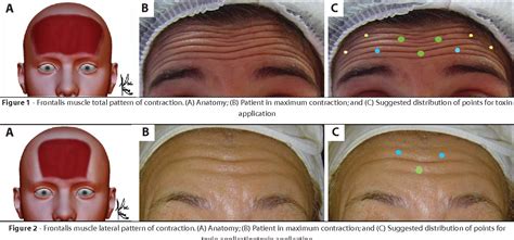Patterns Of Contraction Of The Frontalis Muscle A Pilot Study