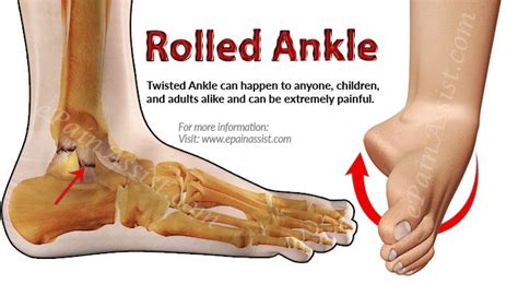 What Is Rolled Ankle Know Its Treatment And Recovery Period