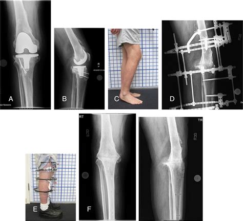 Knee Arthrodesis As Limb Salvage For Complex Failures Of Total Knee