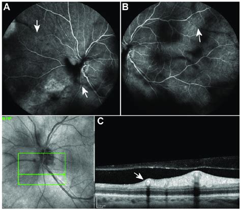 Fluorescein Angiography 2 Weeks After The Initiation Of Treatment