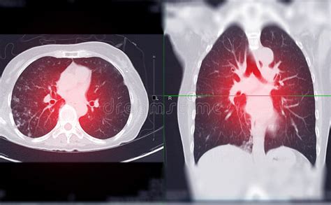 Ct Chest Or Ct Scan Of Lung Axial And Sagittal View Stock Image Image