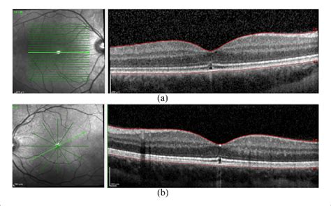 Optical Coherence Tomography Oct Images A Right Eye And B Left Download Scientific