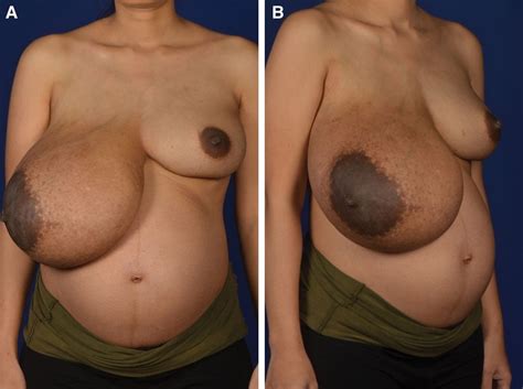 Abnormal Breasts Pics Xhamster