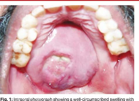 Figure 1 From Polymorphous Low Grade Adenocarcinoma Of The Palate