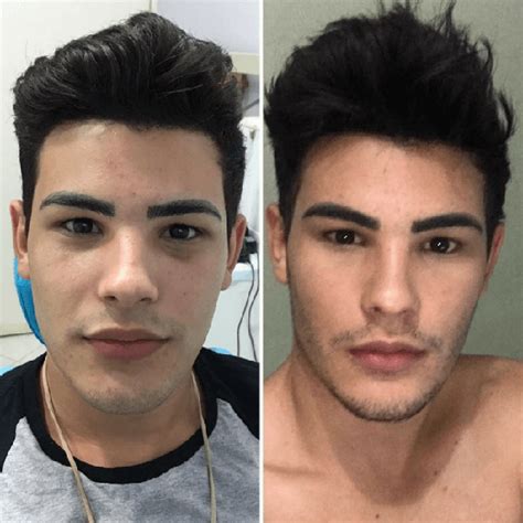 Bichectomy Before And After Photos Can Anyone Show Some