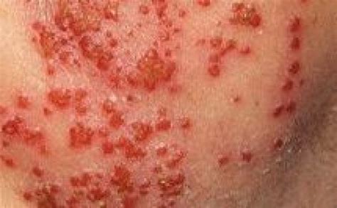 Eczema Herpeticum What Is It And Is It Dangerous Eczema Blues
