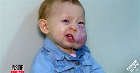 Zij Werd Als Baby Geboren Met Een Tumor Op Haar Gezicht Maar Let Op