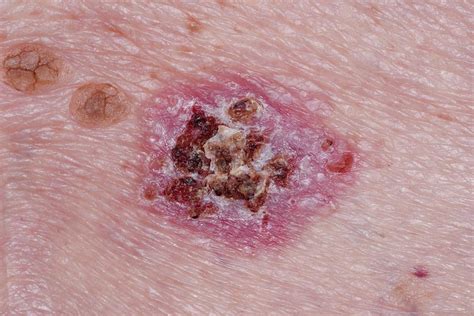 What Is Basal Cell Skin Cancer Images And Photos Finder