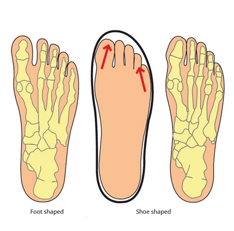 The Science Of Foot Dysfunction And Cure Part 2 Big Toe Position