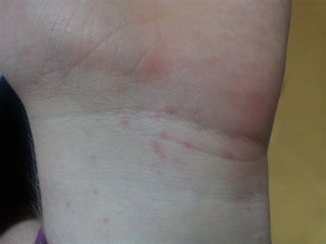 Hey I Just Discovered A Lot Of Red Spots On My Hands Wrist