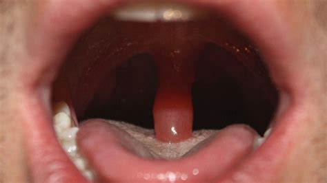 Swollen Enlarged Uvula Causes Symptoms Treatment Home