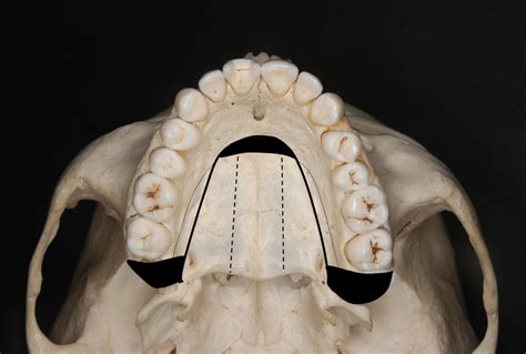 Maxillary Single Jaw Surgery Combining Le Fort I And Modified Horseshoe